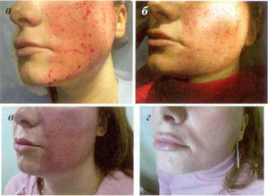 Skin restoration phase after partial ejaculation process