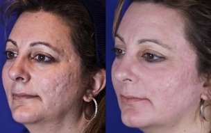 laser shard rejuvenation before and after photos