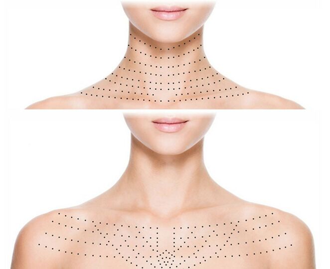 Marks on the skin of the neck and décolleté for a rejuvenating biorevitalization