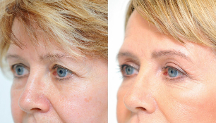 before-and-after blepharoplasty