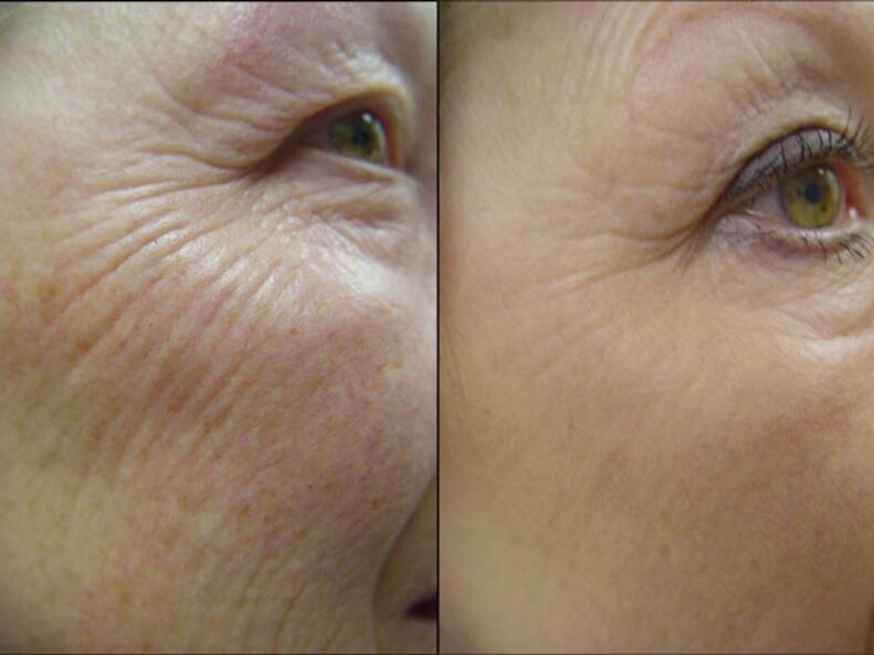 Before and after laser rejuvenation procedures - significant wrinkle reduction
