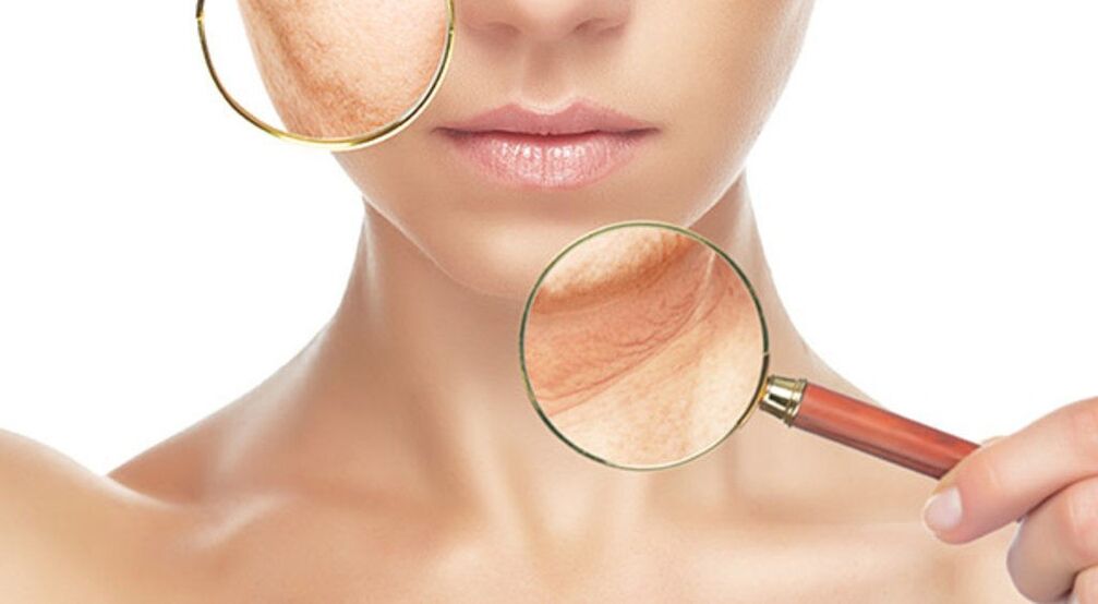 Wrinkles can be effectively removed by laser treatment