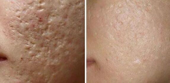 Laser grinds scars