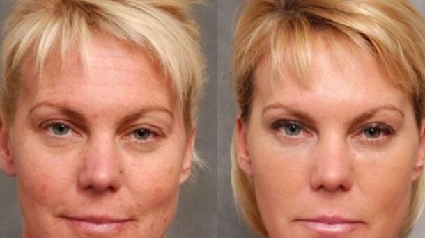 Before and after rejuvenation procedures